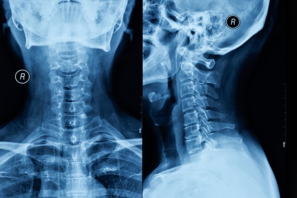 X-Rays - Radiographic Exam​